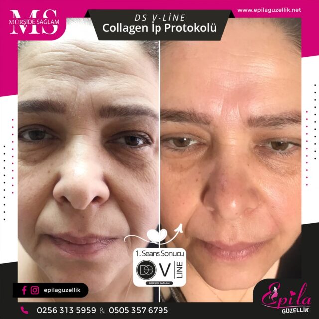 DS V-Line Collagen İp Protokolü - Nazilli