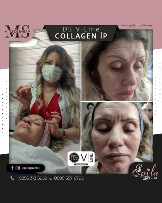 DS V-Line Collagen İp Protokolü - Nazilli