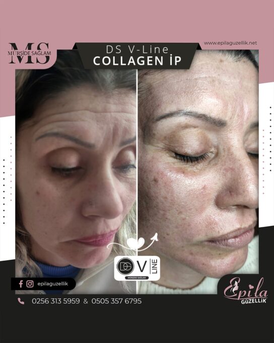 DS V-Line Collagen İp Protokolü - Nazilli