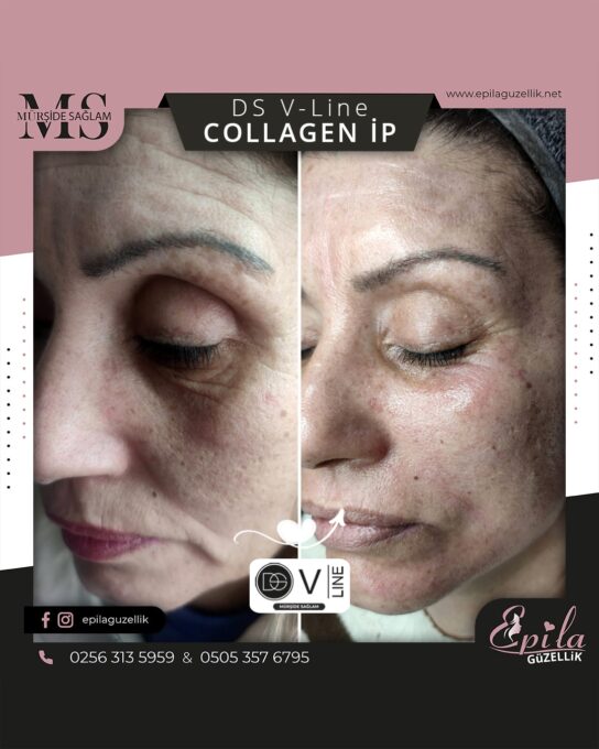 DS V-Line Collagen İp Protokolü - Nazilli