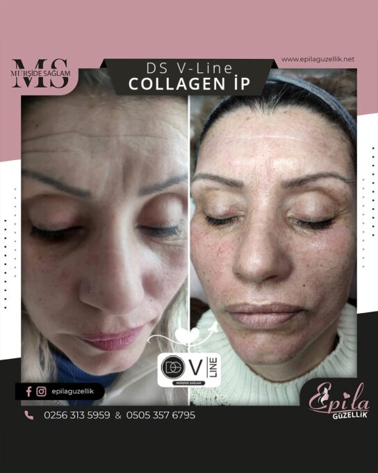 DS V-Line Collagen İp Protokolü - Nazilli