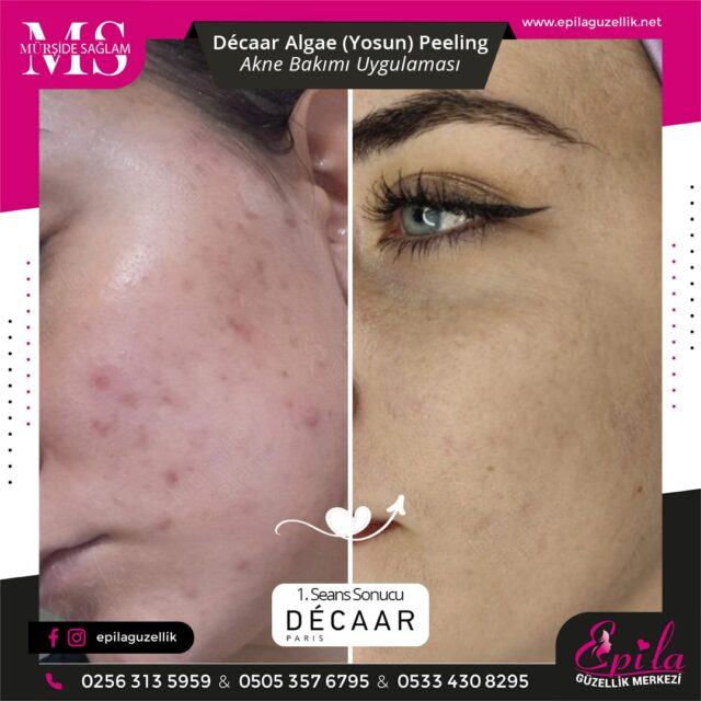 Decaar Algae Yosun Peeling Nazilli