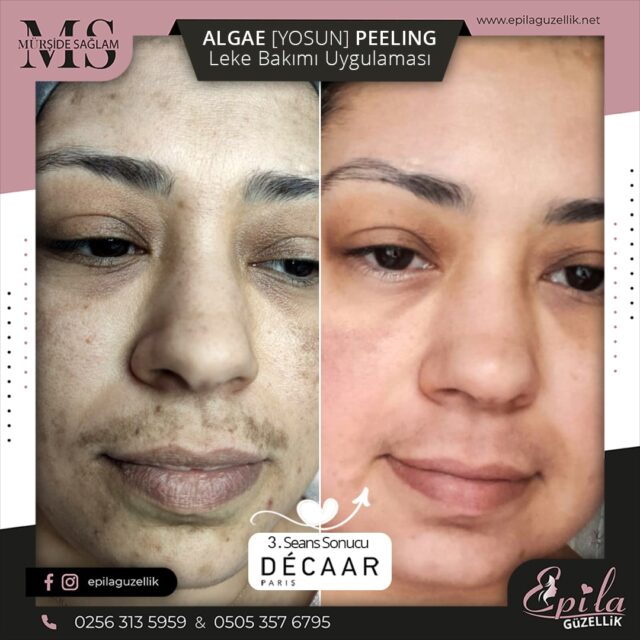 Decaar Algae Yosun Peeling Nazilli