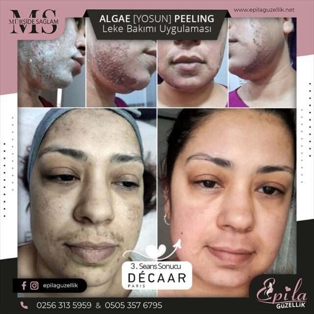 Decaar Algae Yosun Peeling Nazilli